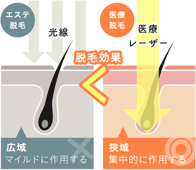 医療脱毛とエステ脱毛の違い